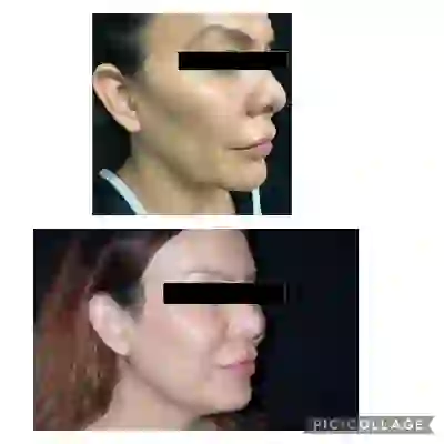 Neck Liposuction - Chin Liposuction - Before-After - 02