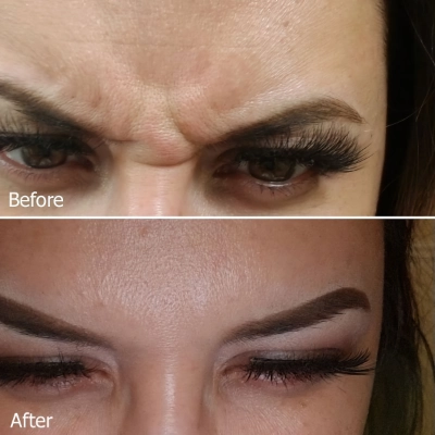 Botox Cosmetic Injections - Botox Before and After