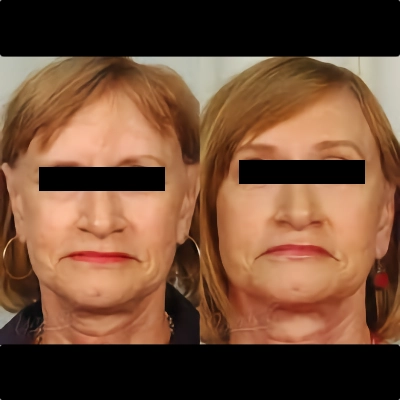Brow Lift - Forehead Lift Surgery