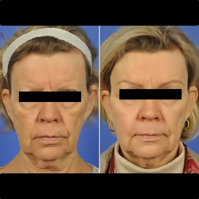 Brow Lift - Forehead Lift Surgery