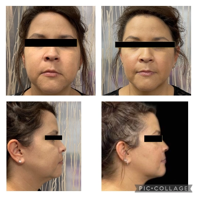 BUCCAL FAT REMOVAL SURGERY
