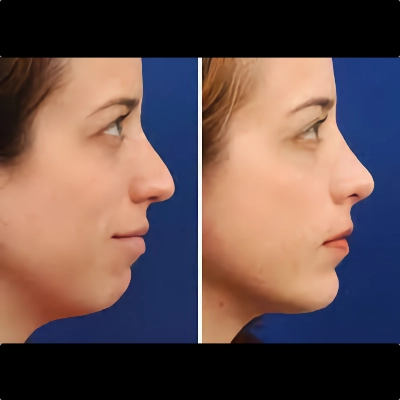 Chin Augmentation Surgery - Chin Implant