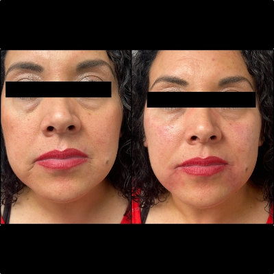 Cosmetic Facial Filler - Marionette Lines