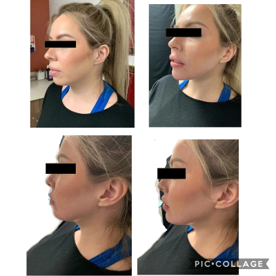 Cosmetic Jawline Contouring