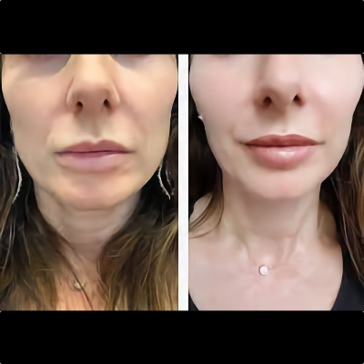 Cosmetic Jawline Contouring