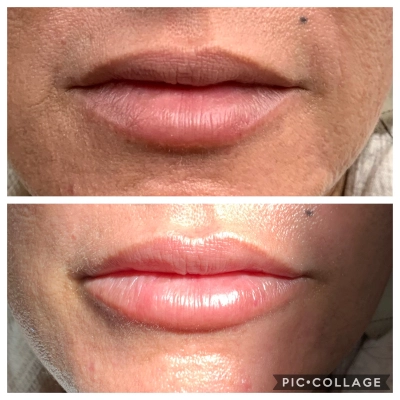 Cosmetic Lip Enhancement - Lip Filler