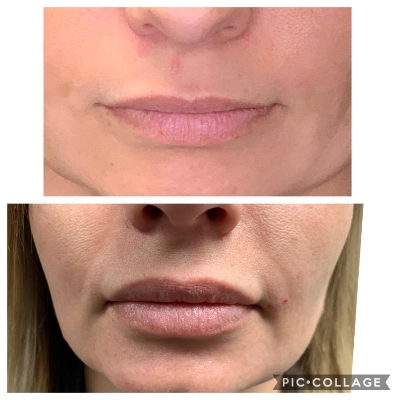 Cosmetic Lip Enhancement - Lip Filler - Juvederm