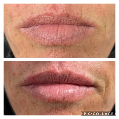Cosmetic Lip Enhancement - Lip Filler - Juvederm