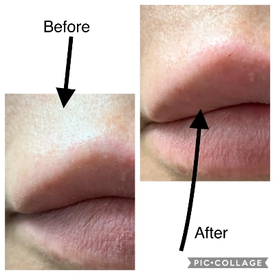 Cosmetic Lip Enhancement - Lip Filler - PDO Thread