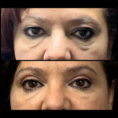 Eyelid Surgery - Eyelid Lift