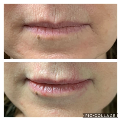 Volbella Lip Enhancement - Lip Filler