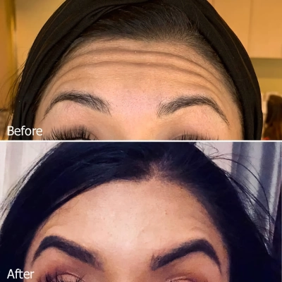 Xeomin Aesthetic Injection Before-After 01