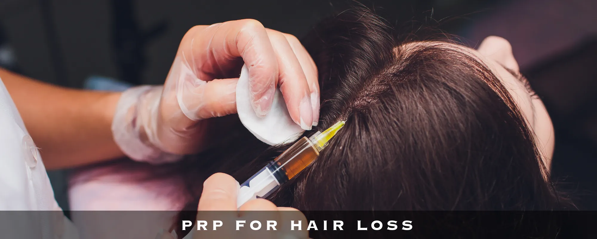 PRP FOR HAIR LOSS