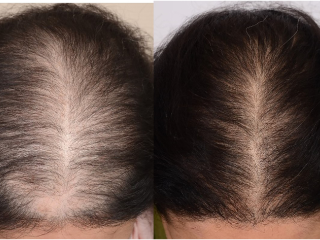 WHAT STUDIES HAVE PROVENT THE PRP PROCESS FOR HAIR LOSS WORKS? (PRP FOR HAIR LOSS FAQ)