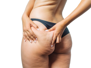 DOES QWO REALLY WORK FOR CELLULITE?