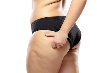 WHO IS A GOOD CANDIDATE FOR QWO CELLULITE TREATMENT?