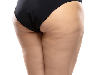 WHAT ARE THE RISKS WITH QWO CELLULITE INJECTIONS?