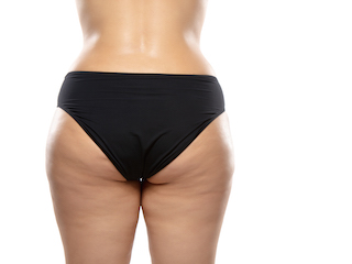 ARE QWO INJECTIONS FOR CELLULITE PAINFUL?