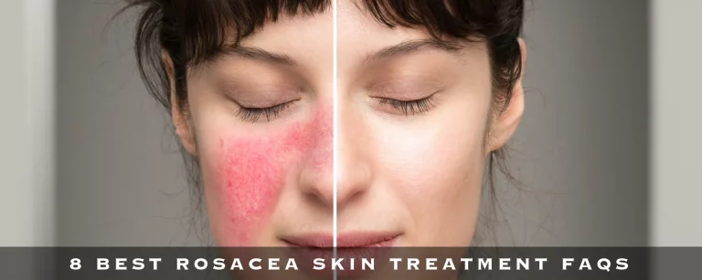 8 Best Rosacea Skin Treatment FAQs