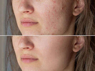 WHAT IS ACNE LASER TREATMENT? 