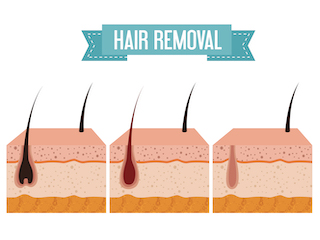 WHAT IS LASER HAIR REMOVAL?