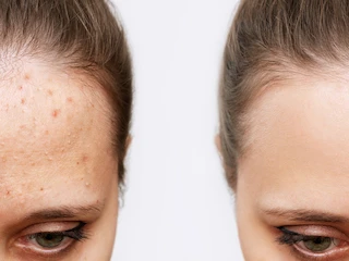 CAN ACNE BE REMOVED PERMANENTLY BY LASER?