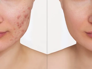 HOW MANY ACNE LASER TREATMENT SESSIONS WILL I NEED?