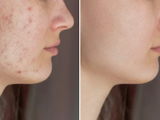 WHAT SHOULD I DO AND NOT DO BEFORE AND AFTER ACNE LASER TREATMENT?
