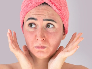 6 - DOES ROSACEA WORSEN WITH AGE?