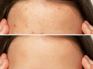 WHAT ARE THE SIDE EFFECTS OF ACNE LASER TREATMENT?