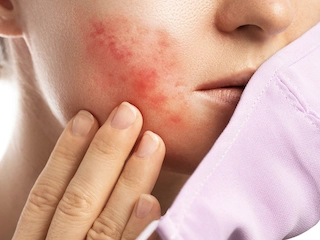 7 - WHO IS MOST LIKELY TO GET ROSACEA?