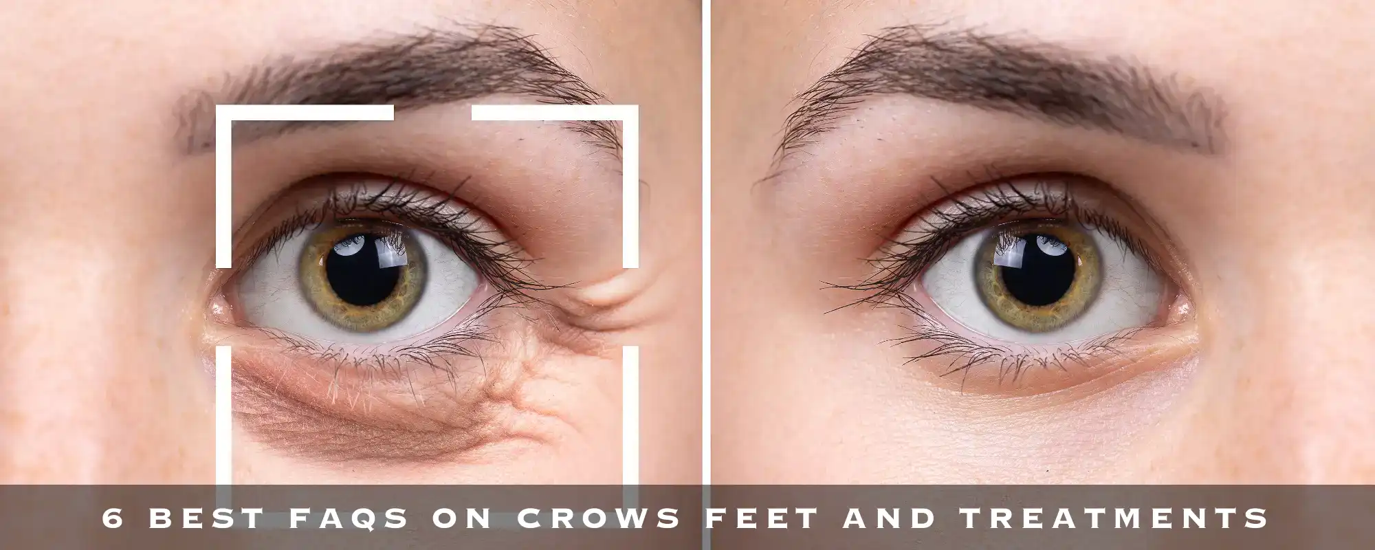 6 BEST FAQS ON CROWS FEET AND TREATMENTS