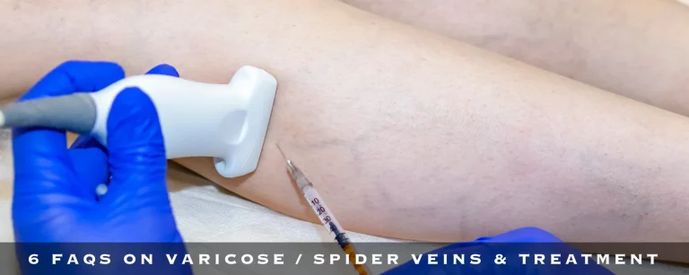 6 Best FAQs on Varicose / Spider Veins & Treatment