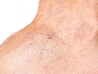 WHAT TREATMENTS CAN I GET FOR VARICOSE / SPIDER VEINS?