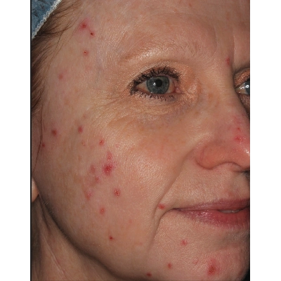 01 - BEFORE - SCITON FOREVER CLEAR BBL ACNE TREATMENT - BEFORE - AFTER