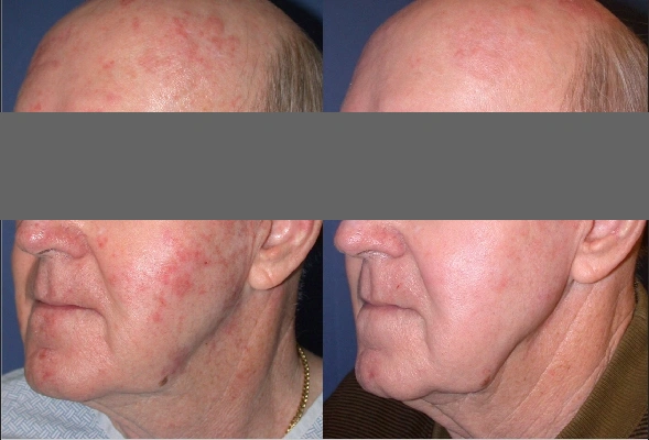 01 - SCITON PROFRACTIONAL LASER TREATMENT - BEFORE-AFTER