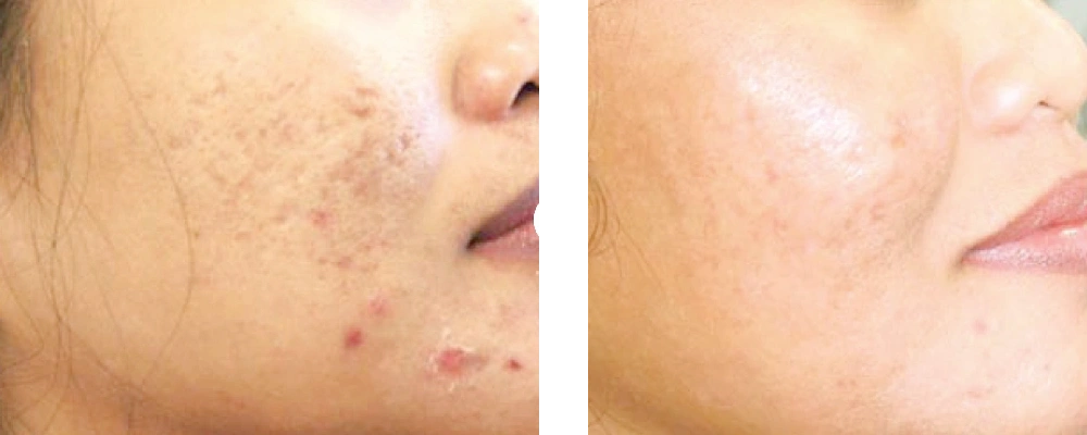 02 - SCITON PROFRACTIONAL LASER TREATMENT - BEFORE-AFTER
