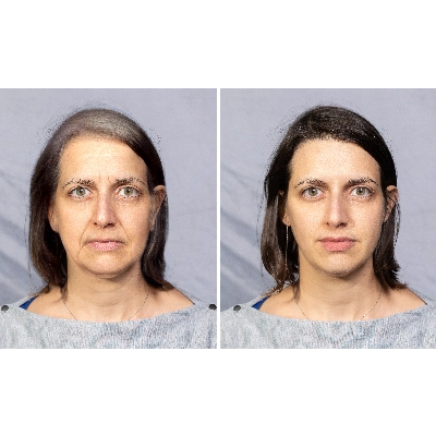 03 - SCITON CONTOUR TRL TREATMENT - BEFORE-AFTER