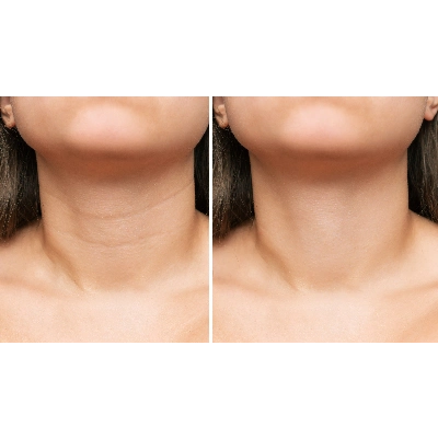 04 - SCITON CONTOUR TRL TREATMENT - BEFORE-AFTER