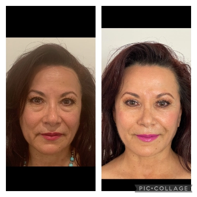 Face Lift - Neck Lift Surgery - Dr Tuggle - Before-After