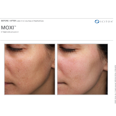 MOXI Laser Laser Treatment - Before-After - 01