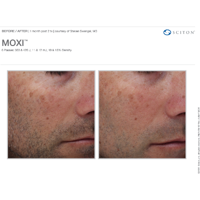 MOXI Laser Laser Treatment - Before-After - 02