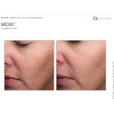 MOXI Laser Laser Treatment - Before-After - 03