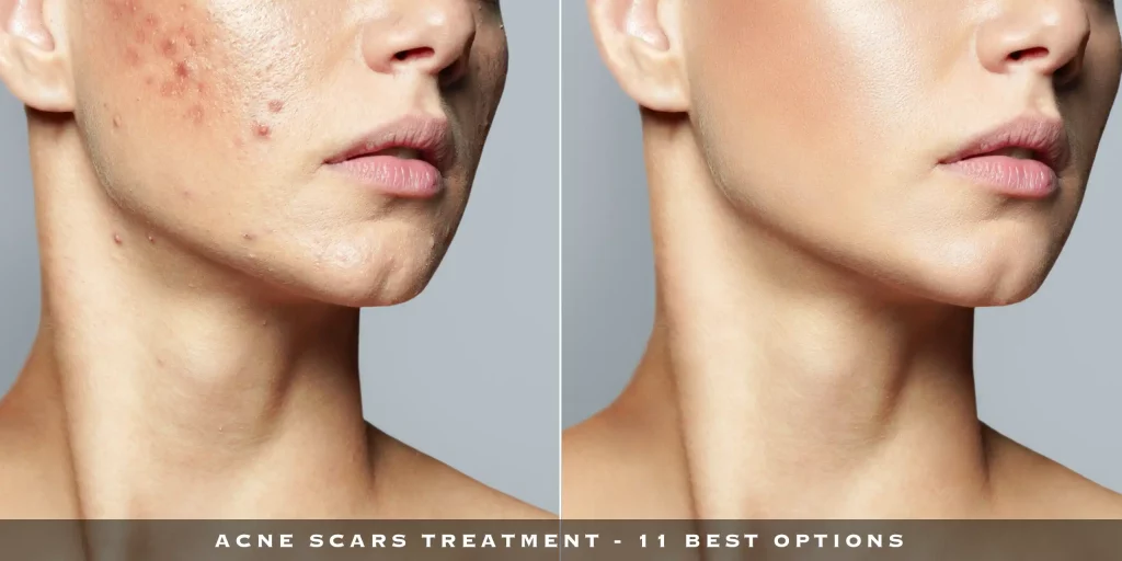 ACNE SCARS TREATMENT - 11 BEST OPTIONS