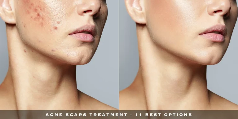 Acne Scars Treatment – 11 Best Options