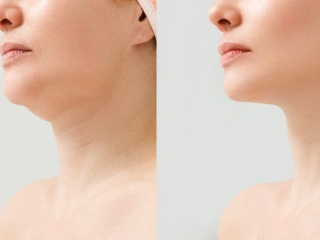 JUVEDERM INJECTIONS TO BUILD UP A WEAK JAWLINE