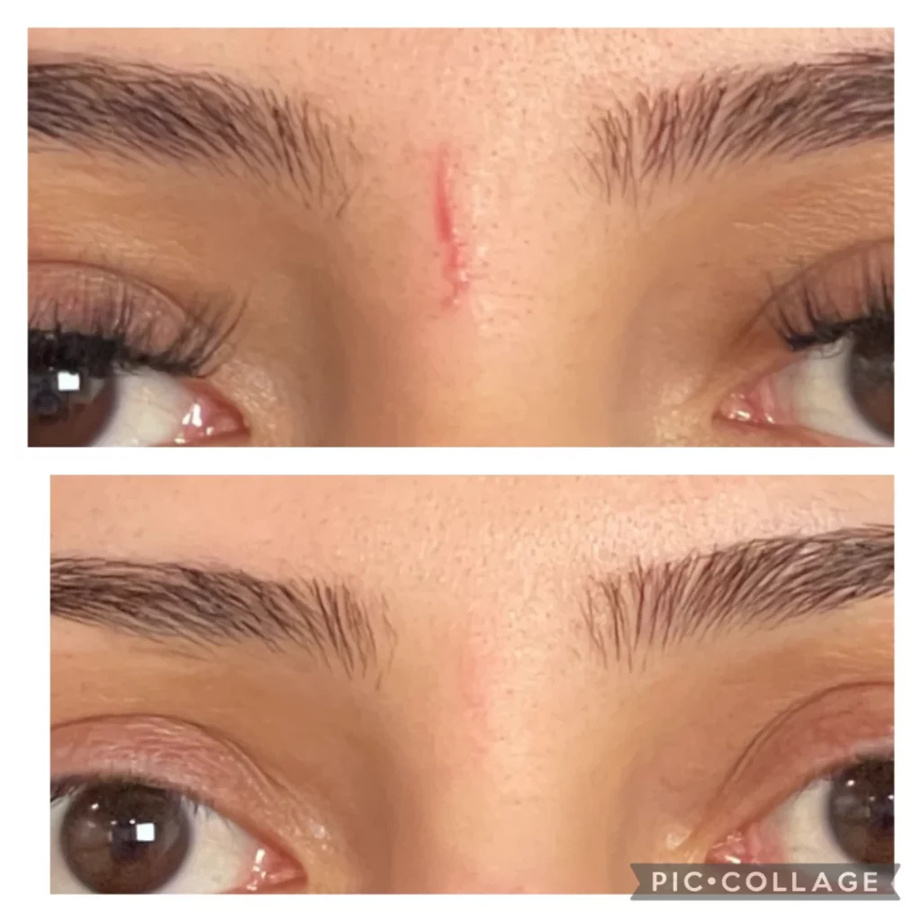 Before-After Scar Treatment