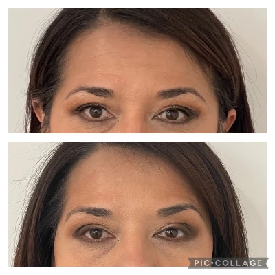 Botox Cosmetic Injections - Botox Before and After