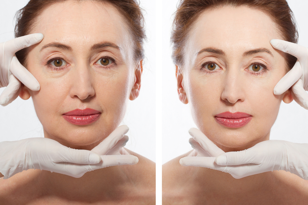 Before and after results of Juvederm Skinvive showing reduced fine lines and improved skin texture.