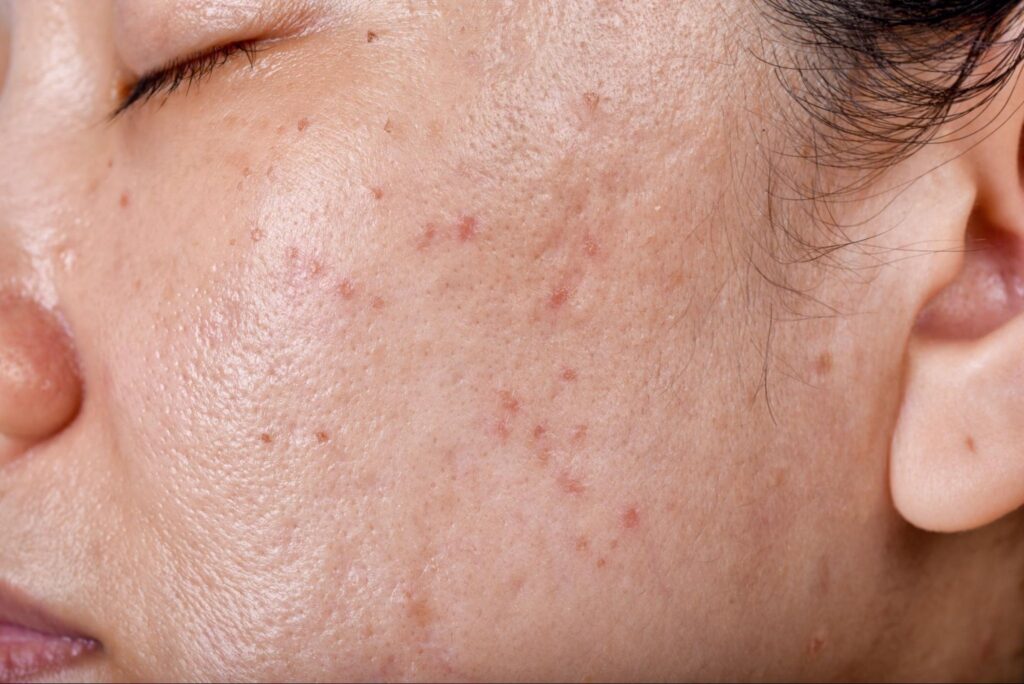 Patient receiving MOXI® laser treatment at Sandia Skin + Face for skin rejuvenation.